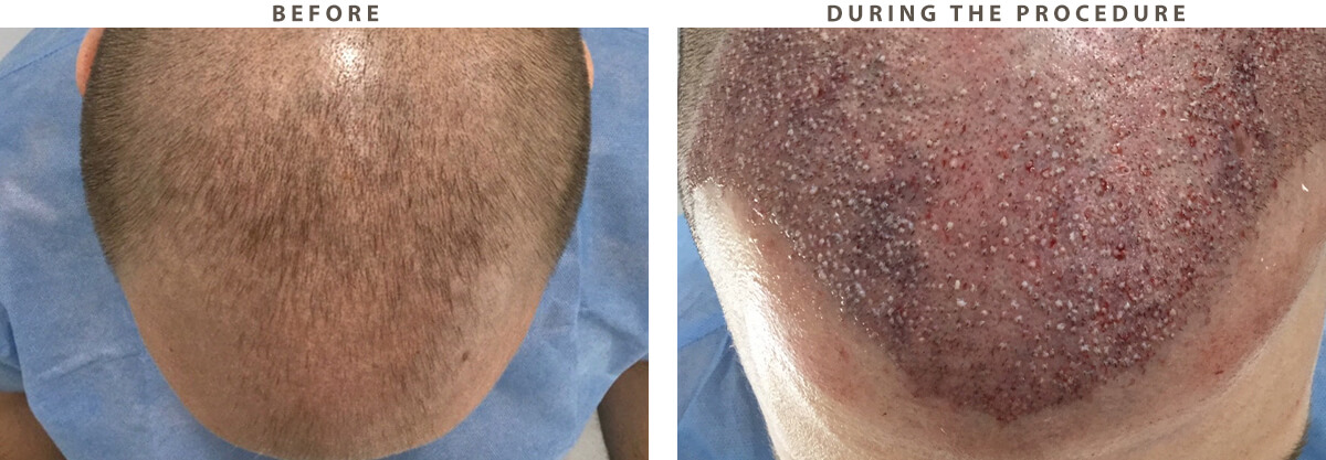 Artas Hair Transplant - Before and After Pictures