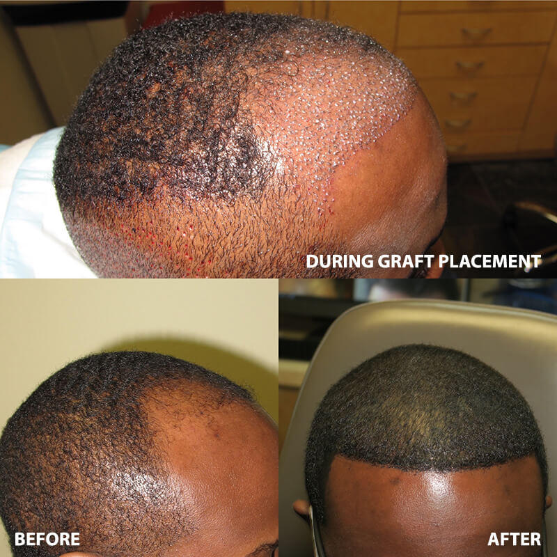 ARTAS Hair Restoration - Before and After Pictures