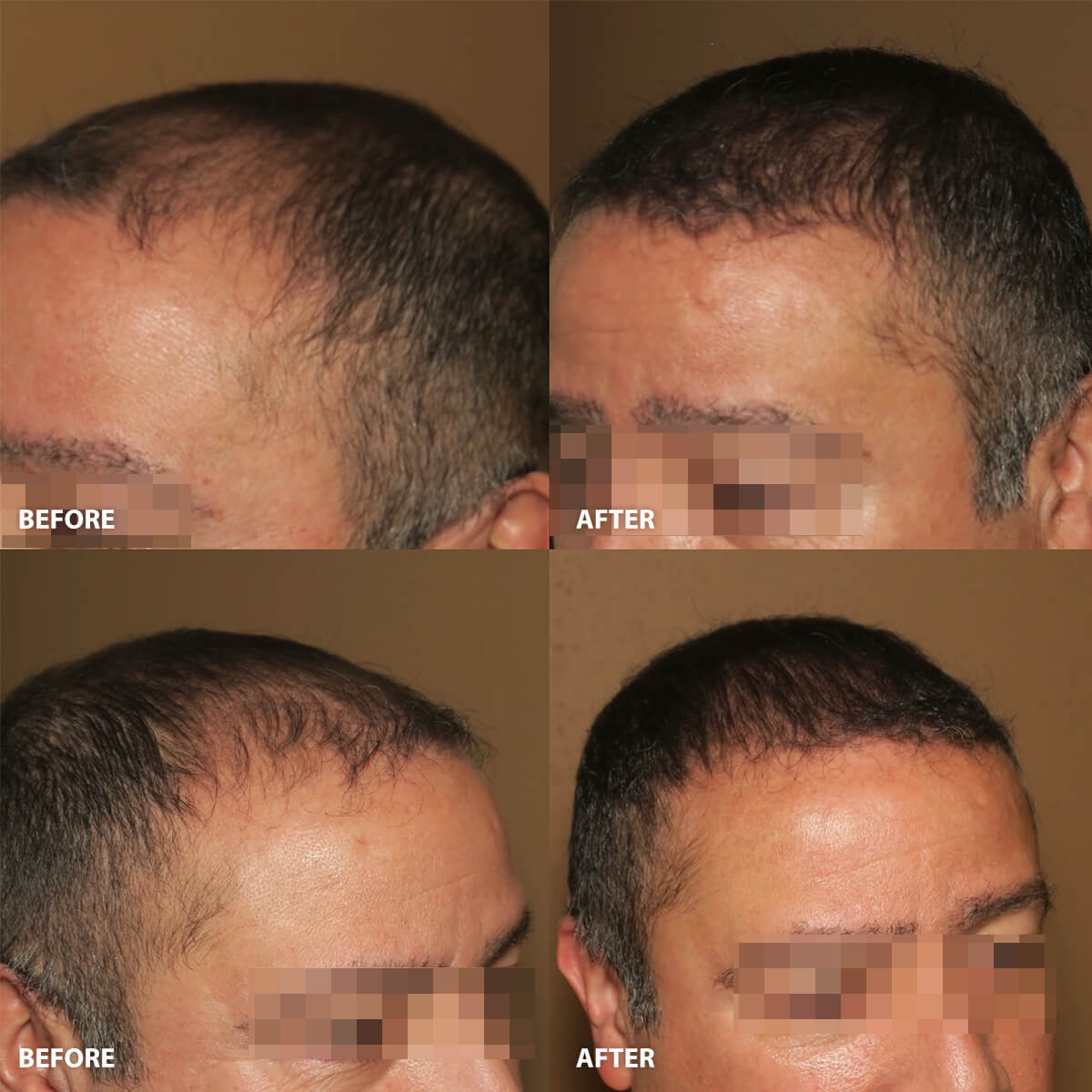 ARTAS Hair Transplantation - Before and After Pictures