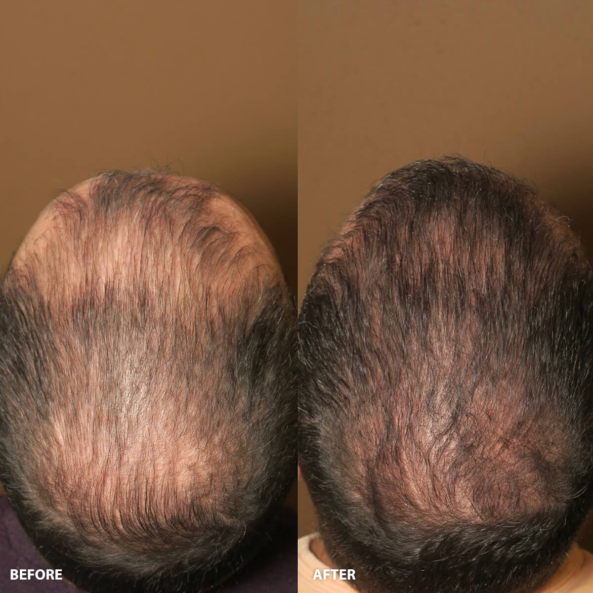 ARTAS Hair Transplantation - Before and After Pictures