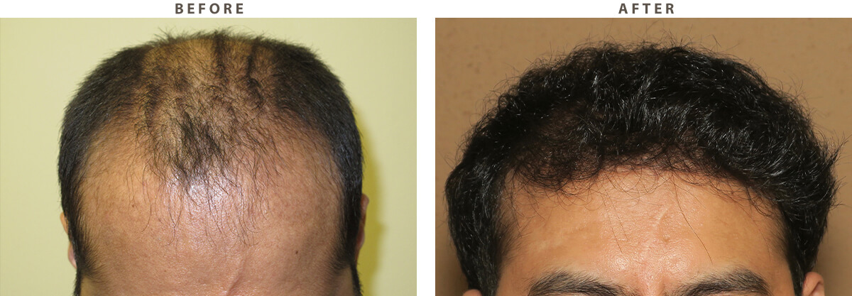 ARTAS - Before and After Pictures