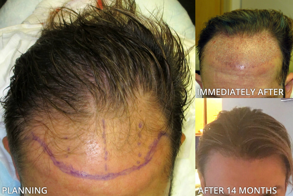 Before And After Picutres ARTAS Robotic Hair Transplant