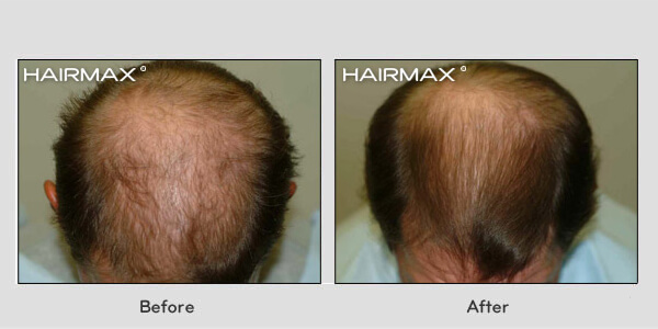 Hair Loss LaserComb Before & After Photos - Males