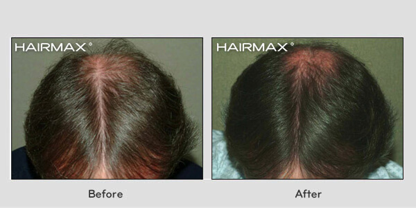 Hair Loss LaserComb Before & After Photos - Males