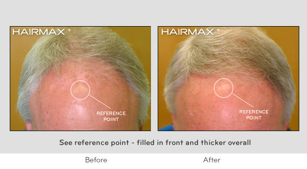 Hair Loss LaserComb Before & After Photos - Males
