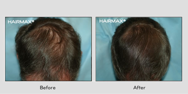 Hair Loss LaserComb Before & After Photos - Males
