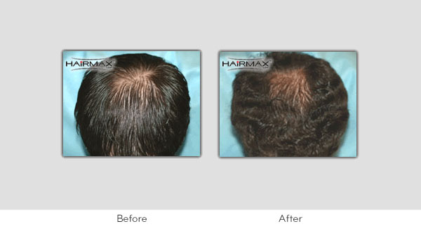 Hair Loss LaserComb Before & After Photos - Males