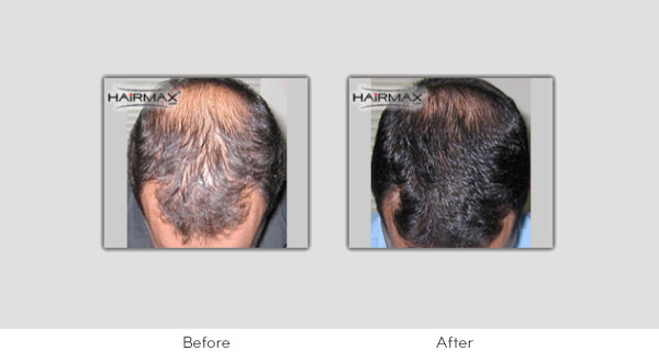 Hair Loss LaserComb Before & After Photos - Males