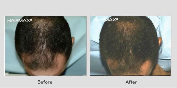 Hair Loss LaserComb Before & After Photos - Males