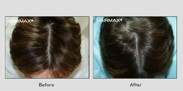 Hair Loss LaserComb Before & After Photos - Males