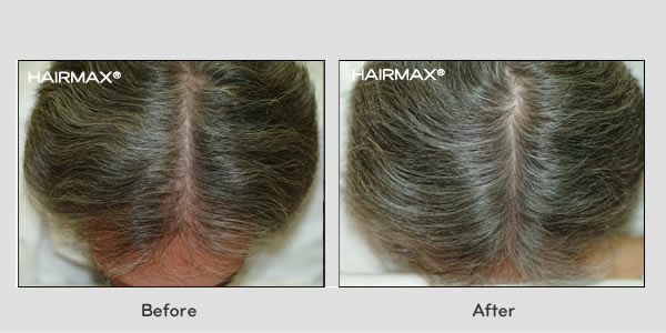 Hair Loss LaserComb Before & After Photos - Males