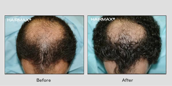 Hair Loss LaserComb Before & After Photos - Males