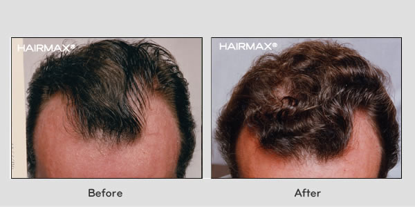 Hair Loss LaserComb Before & After Photos - Males