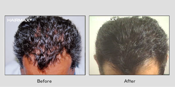 Hair Loss LaserComb Before & After Photos - Males