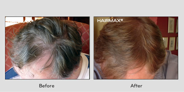 Hair Loss LaserComb Before & After Photos - Males