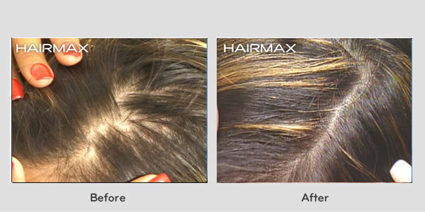 Hair Loss LaserComb Before & After Photos - Female Results