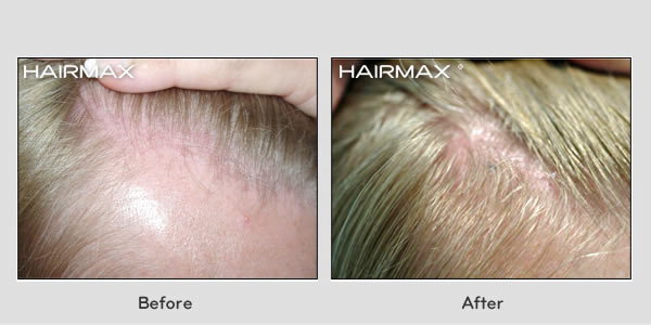 Hair Loss LaserComb Before & After Photos - Female Results