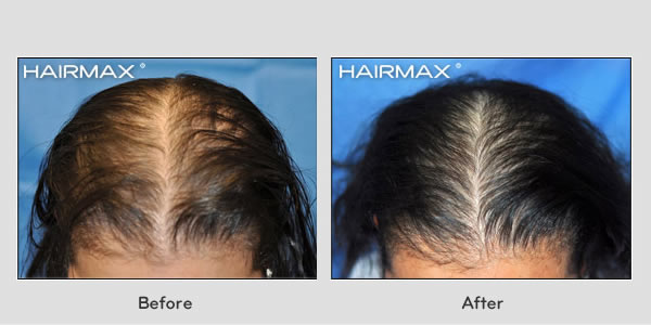 Hair Loss LaserComb Before & After Photos - Female Results