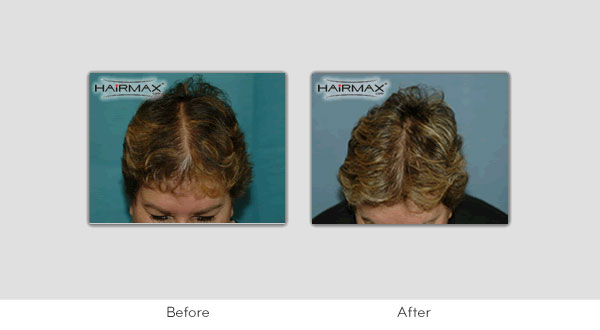 Hair Loss LaserComb Before & After Photos - Female Results