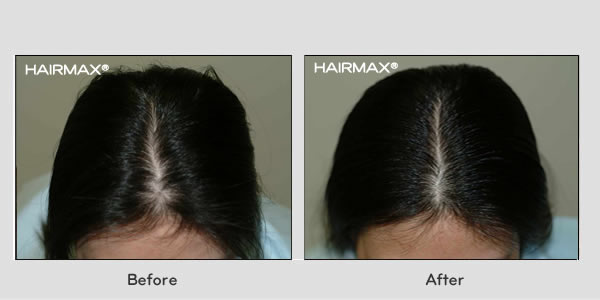 Hair Loss LaserComb Before & After Photos - Female Results