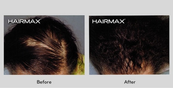 Hair Loss LaserComb Before & After Photos - Female Results