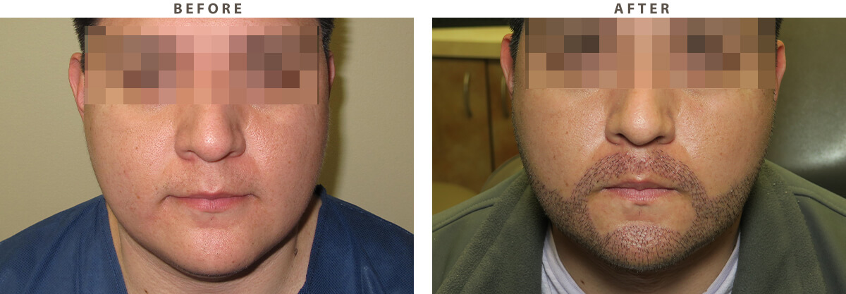 Beard Transplant - Before and After Pictures