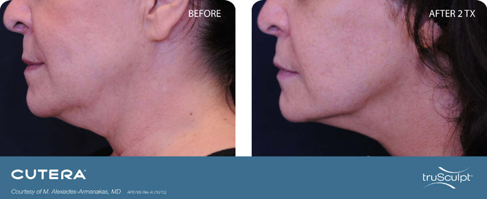 truSculpt-Submentum-before-and-after-pictures