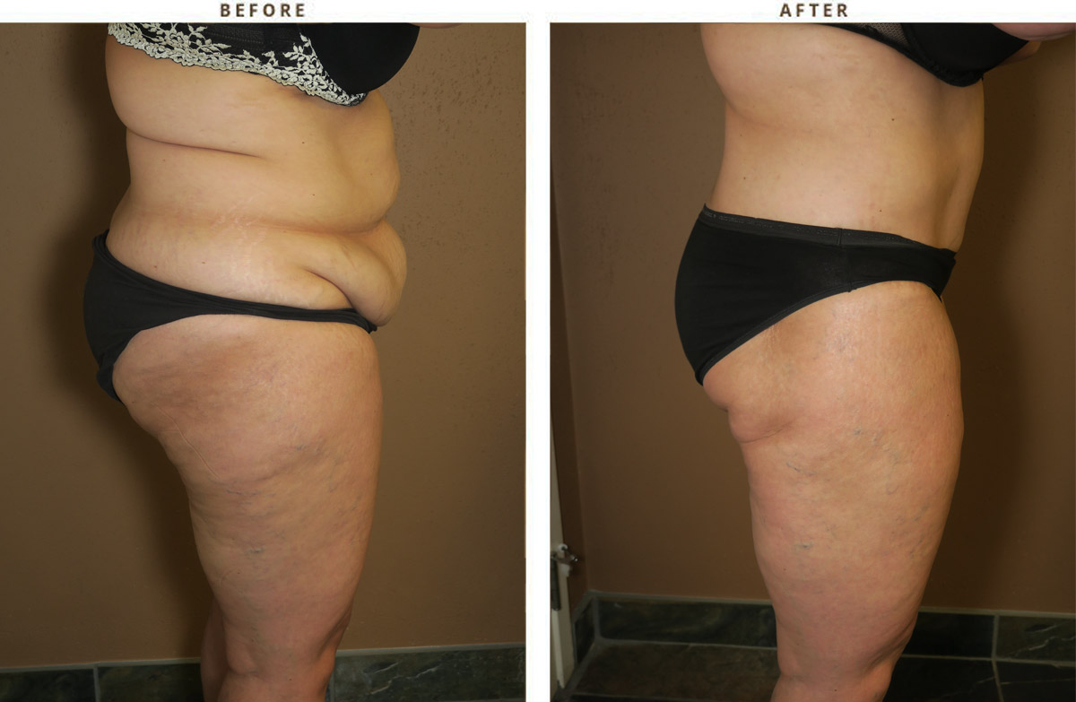 Body Lift - Before and After Pictures
