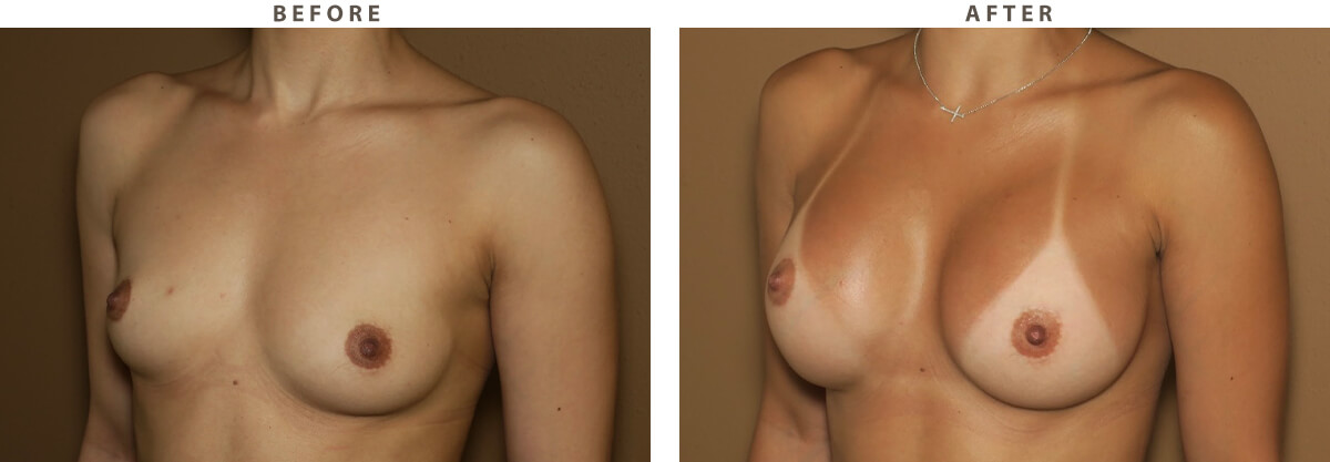Bilateral Breast Augmentation - Before and After Pictures