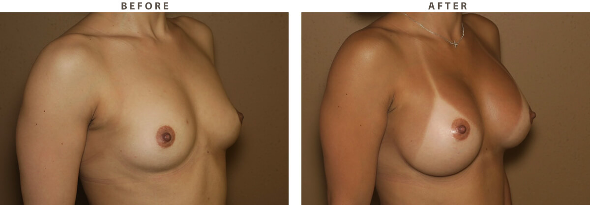 Bilateral Breast Augmentation - Before and After Pictures