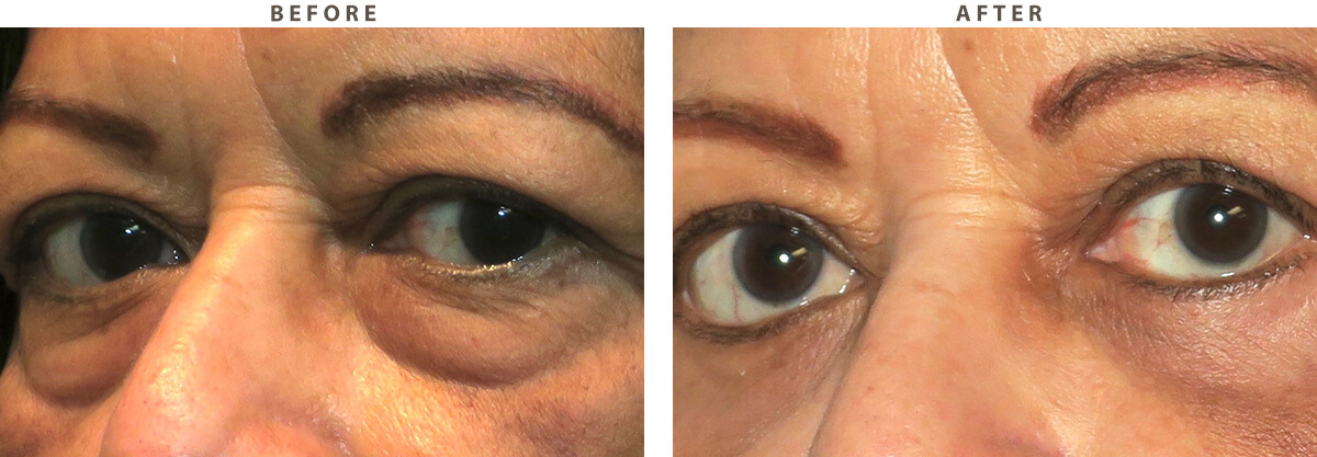 Blepharoplasty - Before and After Pictures
