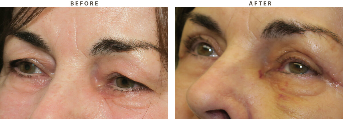 Blepharoplasty - Before and After Pictures