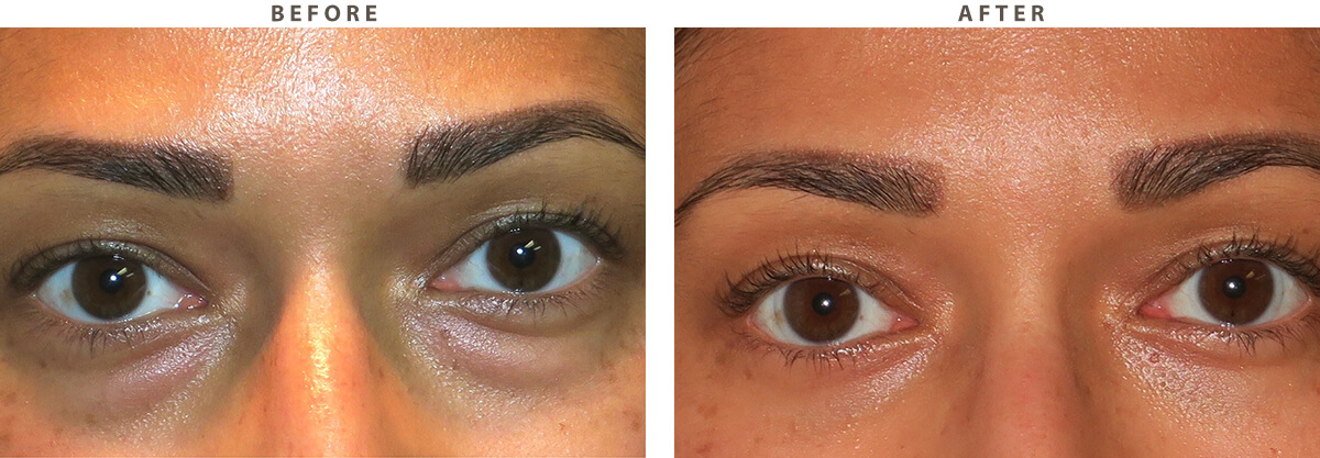Lower blepharoplasty - Before and After Pictures