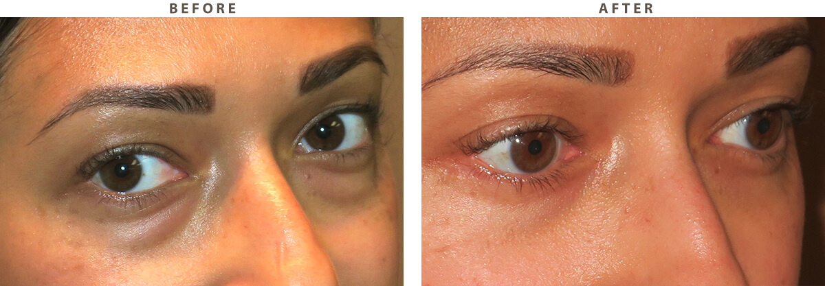 Lower blepharoplasty - Before and After Pictures