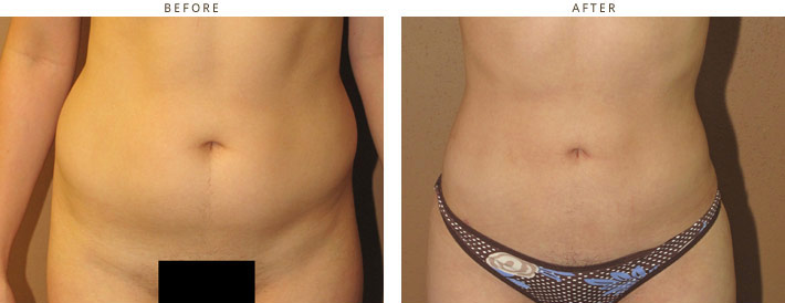 Brazilian Buttock Lift – Before and After Pictures