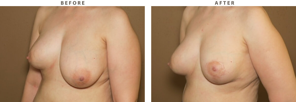 Breast asymmetry - Before and After Pictures