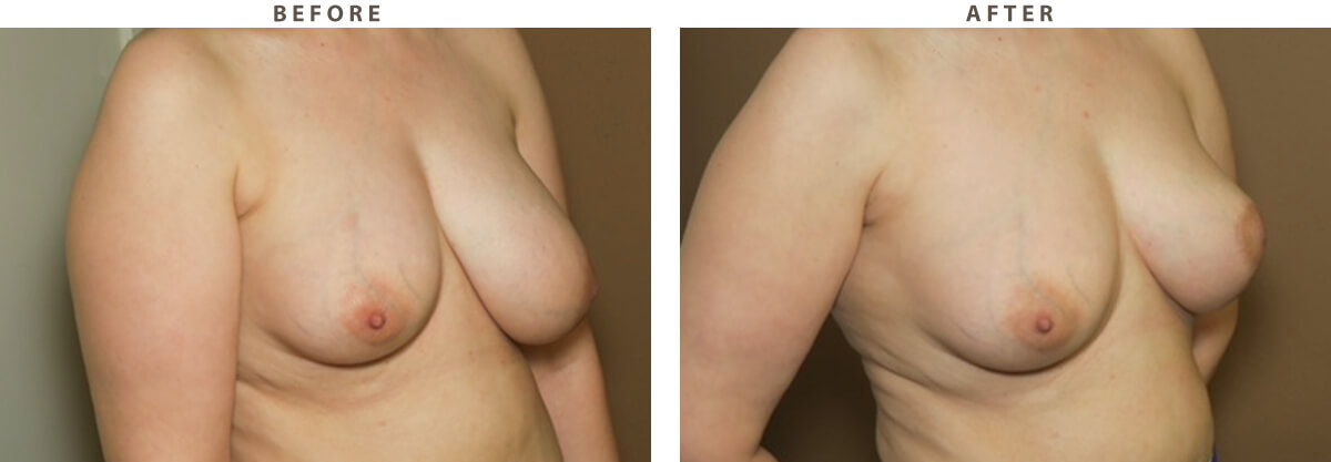 Breast asymmetry - Before and After Pictures
