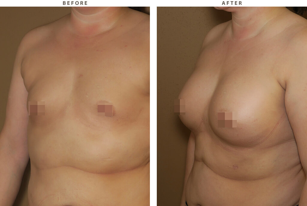Breast Augmentation/Liposuction - Before and After Pictures