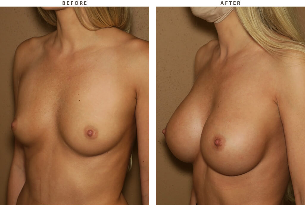 Breast Augmentation - Before and After Pictures
