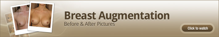 Breast Augmentation - before & after pictures