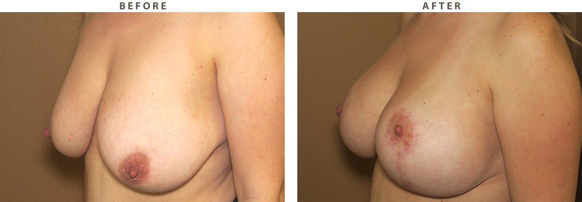 Breast lift - Before and After Pictures