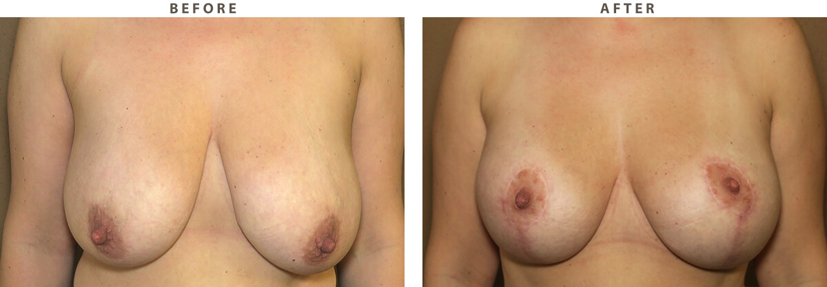 Breast lift - Before and After Pictures