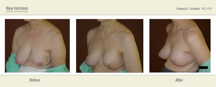 Breast Reconstruction - Before and After Pictures