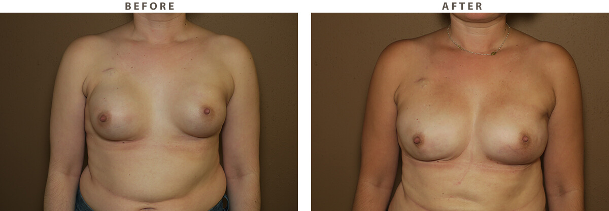 Bilateral Breast Reconstruction - Before and After Pictures