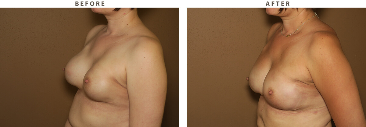 Bilateral Breast Reconstruction - Before and After Pictures