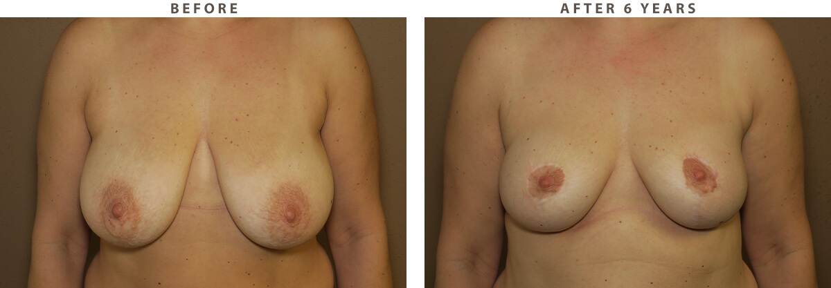 Breast Reduction Chicago - Before and After Pictures