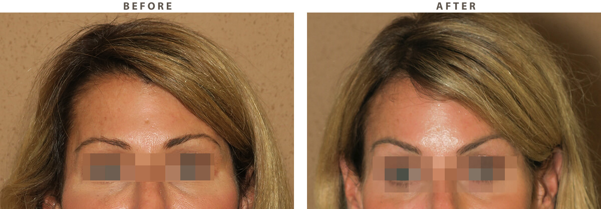 Endoscopic Brow Lift - Before and After Pictures