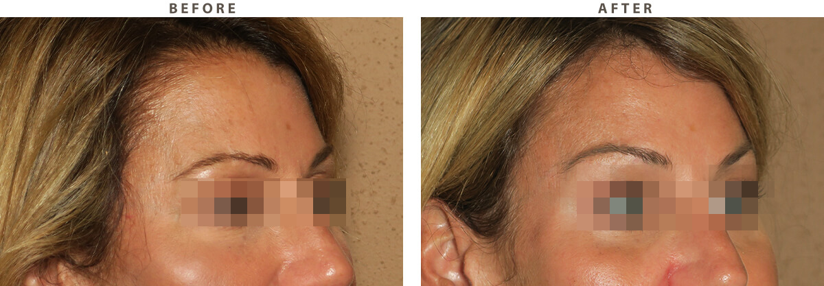 Endoscopic Brow Lift - Before and After Pictures
