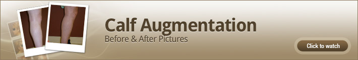 Calf Augmentation - Before and After Pictures