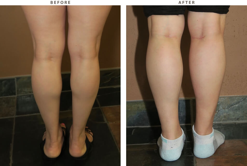 Calf Implants - Before and After Pictures